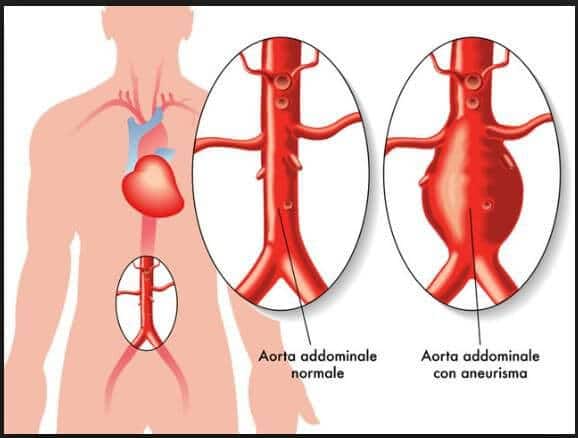 aneurisma torino