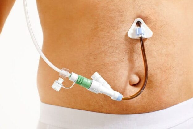 gestione infermieristica peg Torino