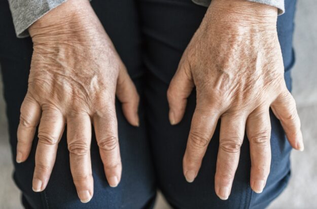 Le quattro malattie della pelle più comuni negli anziani
